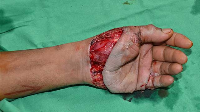 4168-Degloving-642x361-degloving_on_foot-slide2.jpg