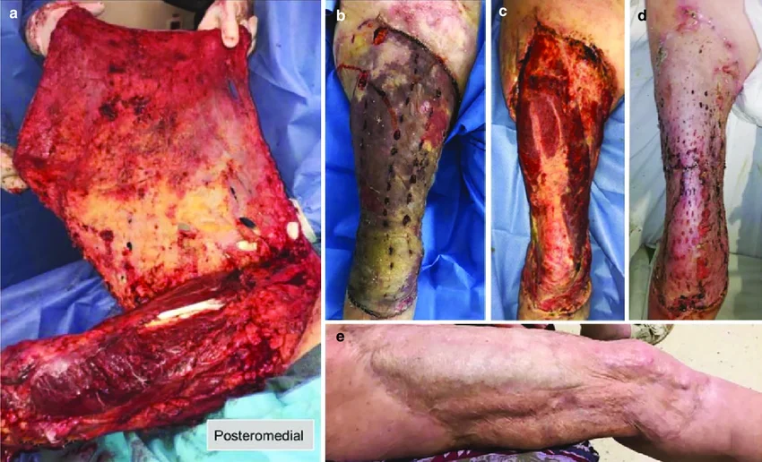 a-Severe-open-degloving-injury-in-the-right-thigh-of-a-55-year-old-patient-She-was.webp