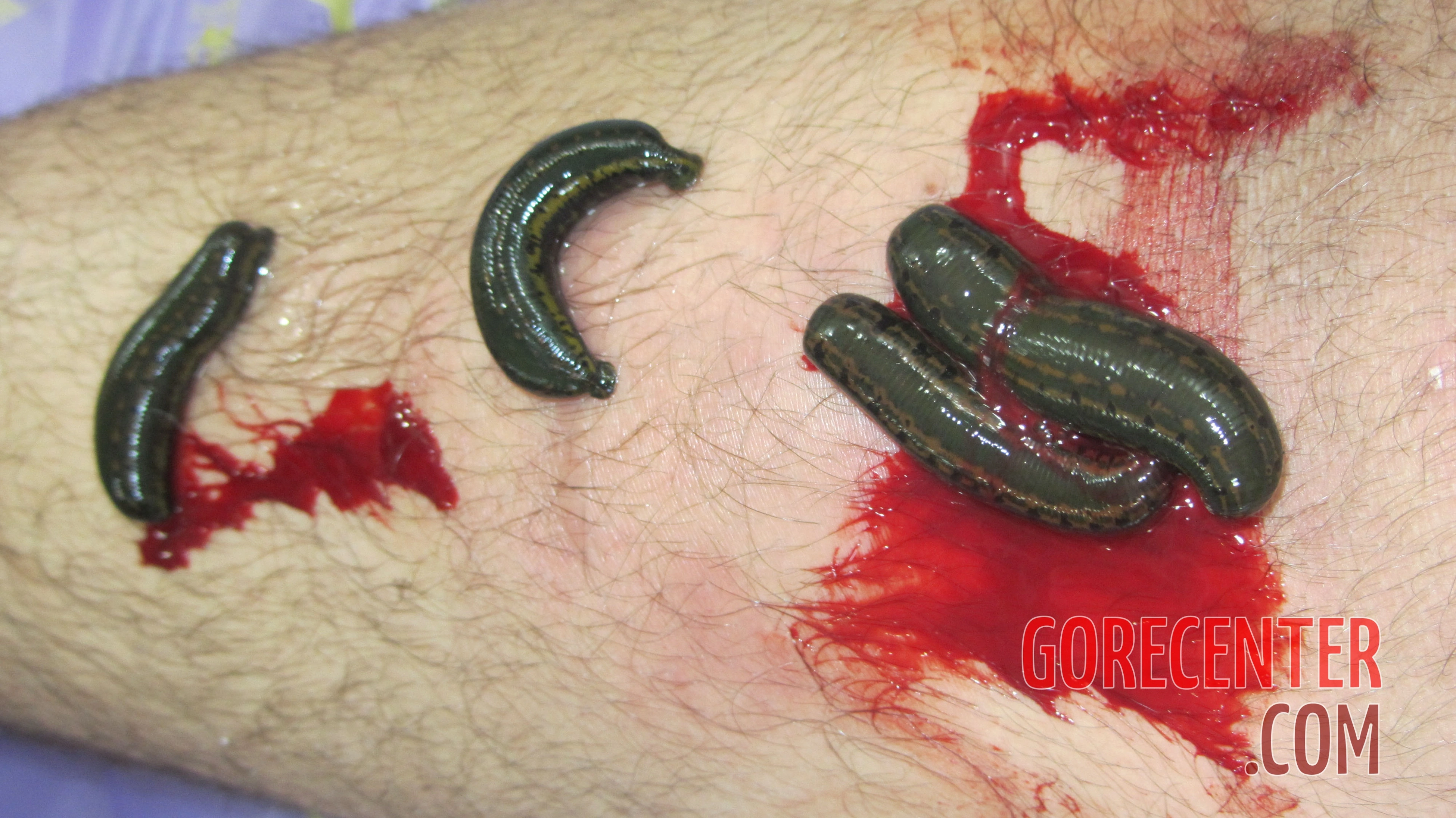 Alternative-medicine-with-leeches-1.webp