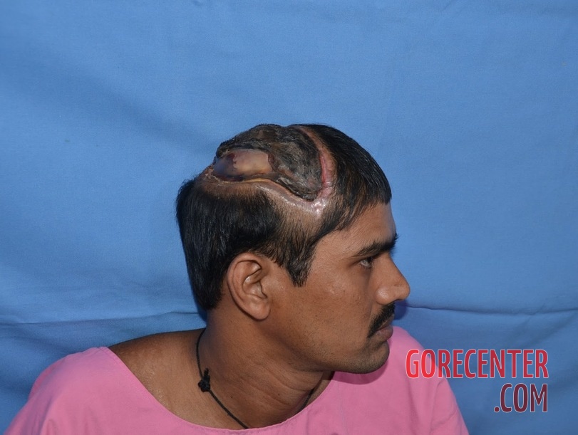 Auto-transplantation-of-skin-on-head-1.jpeg