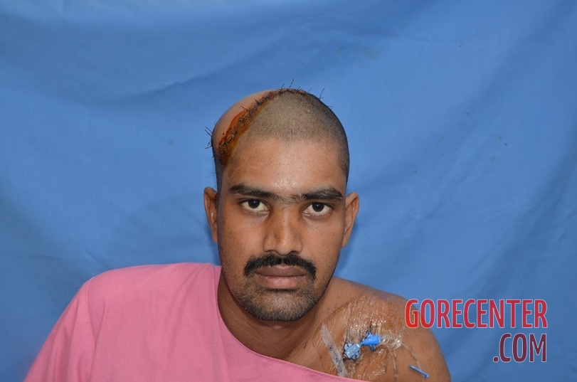 Auto-transplantation-of-skin-on-head-11.jpeg