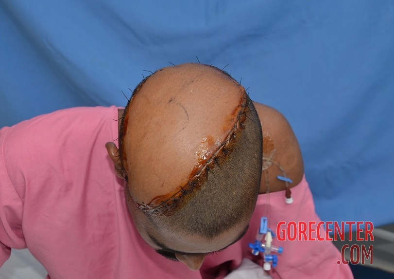 Auto-transplantation-of-skin-on-head-12.jpeg