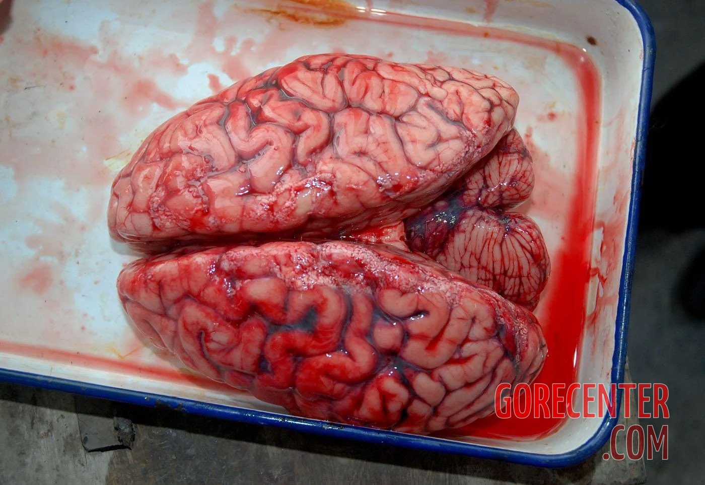 Autopsy-of-brain-after-stroke-2.jpg