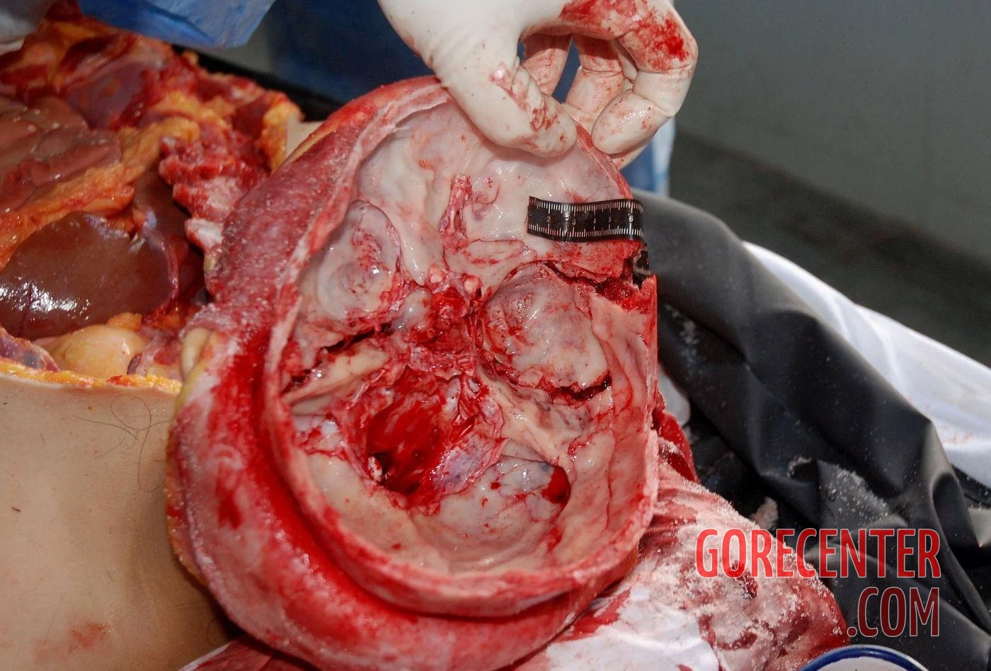 Autopsy-of-brain-after-stroke-3.jpg