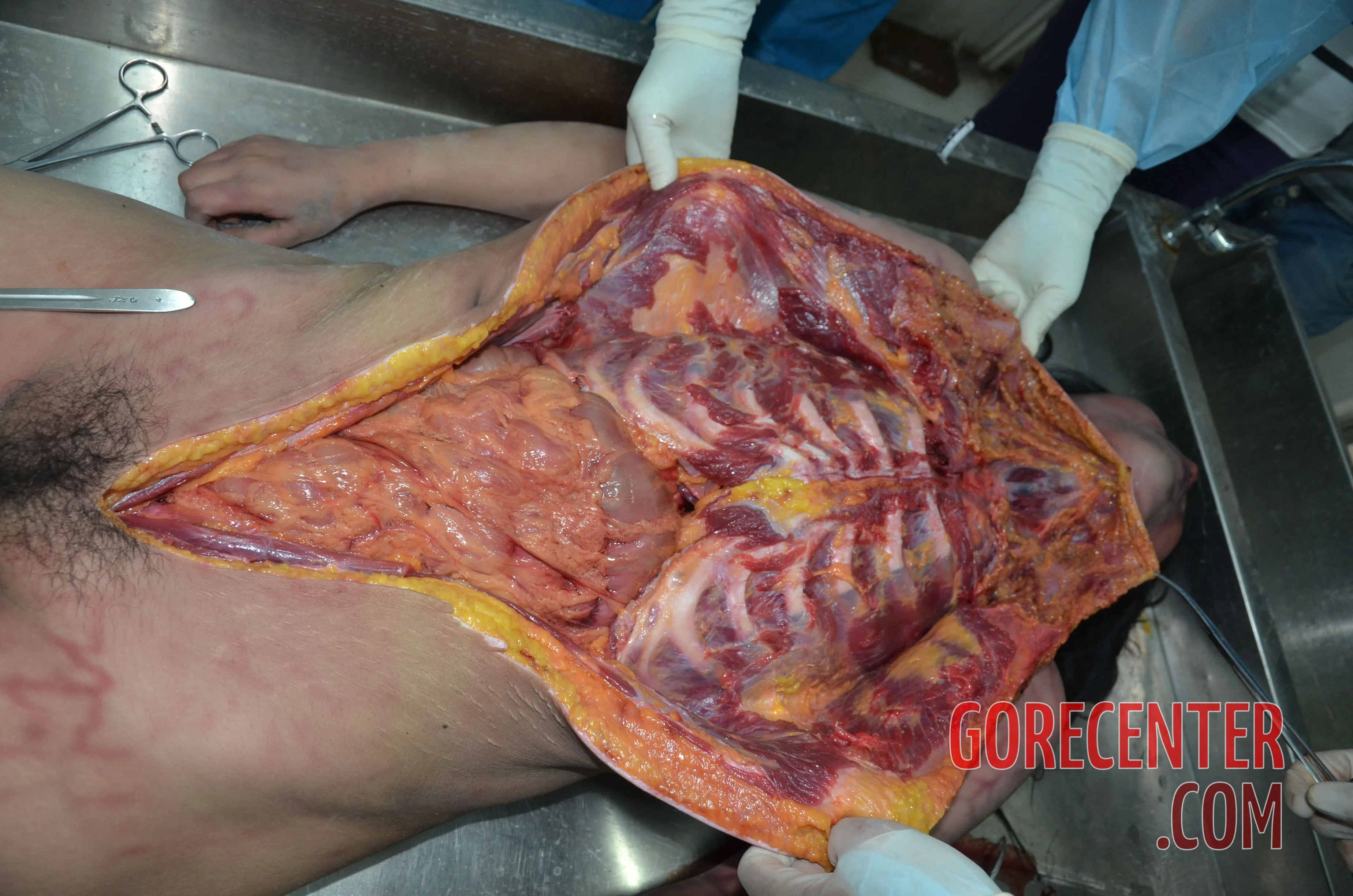 Autopsy-of-strangled-Chinese-woman-12.webp