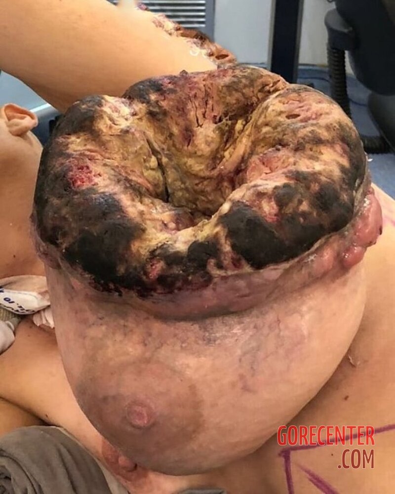 Breast-cancer-surgery-in-extreme-stage-2.jpeg