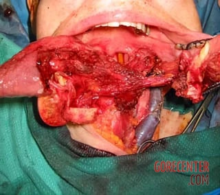 Consequences-of-oral-cancer-3.jpg