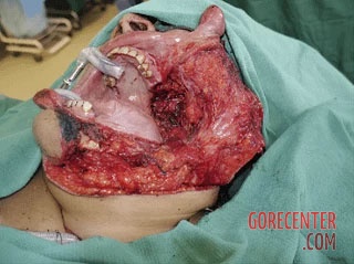 Consequences-of-oral-cancer-7.jpg