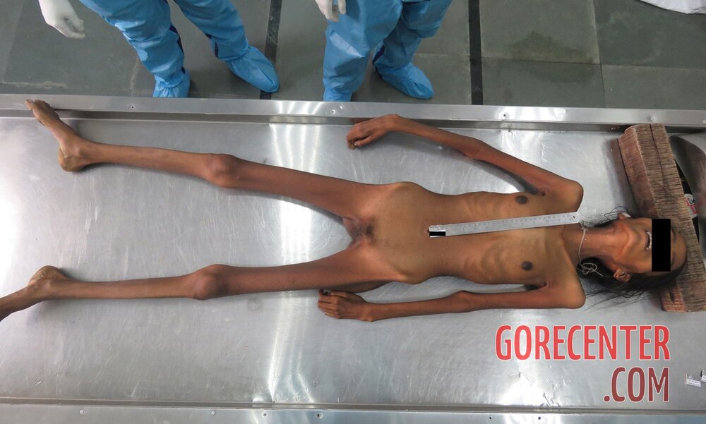 Dead-pregnant-anorexic-1.jpg