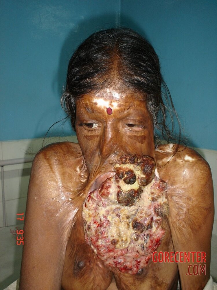 Disfigured-woman-due-to-skin-disease.jpeg