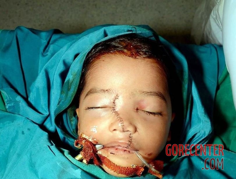 Doctors-removed-a-fence-from-face-of-7-year-old-boy-4.jpeg