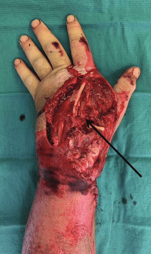 Dorsal-degloving-injury-of-the-hand-and-wrist-after-rollover-atV-accident-with-exposed.png