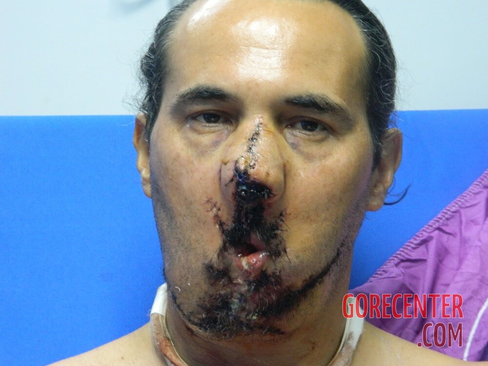 Dude-with-part-of-his-face-blown-off-undergoes-surgery-58.jpg