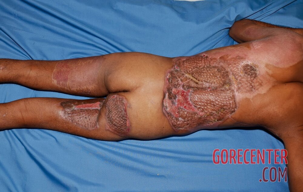 Extreme-electrical-burns-23.jpg