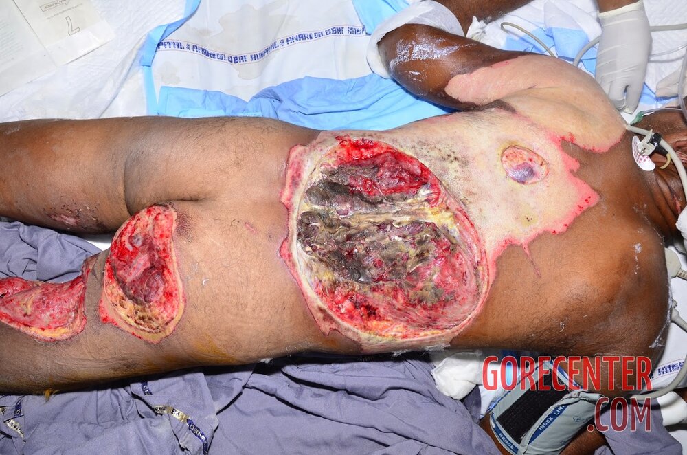 Extreme-electrical-burns-5.jpg