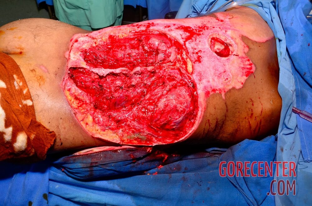 Extreme-electrical-burns-7.jpg