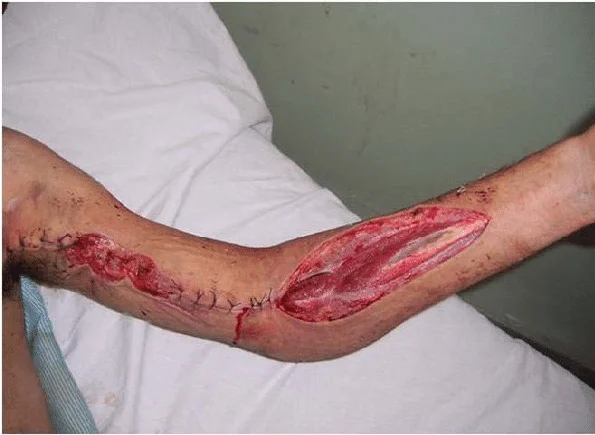 Fasciotomy-of-the-forearm-and-partial-wound-closure-following-brachial-artery-repair-The.webp