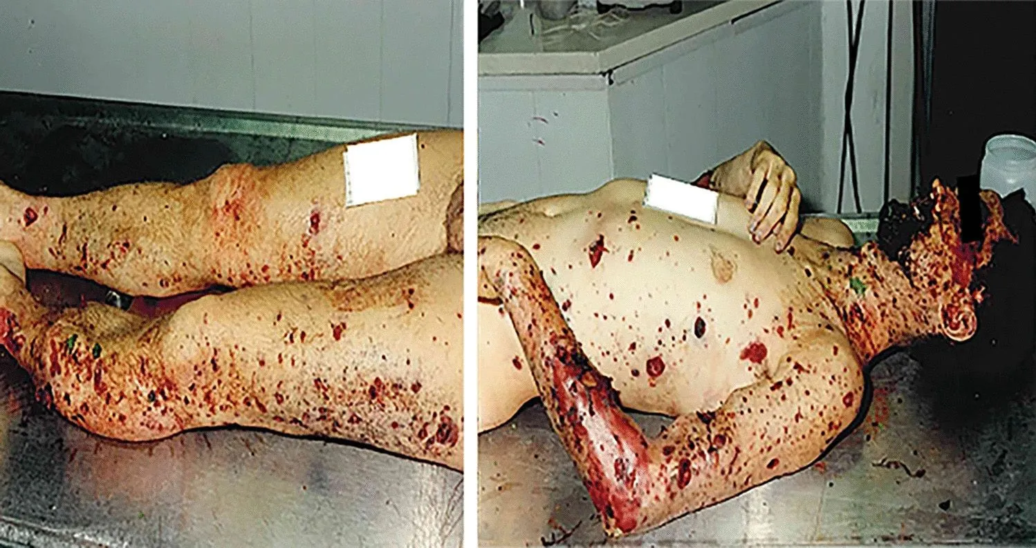 injuries were caused by an explosive device (trinitrotoluene), which was hidden in a car.webp