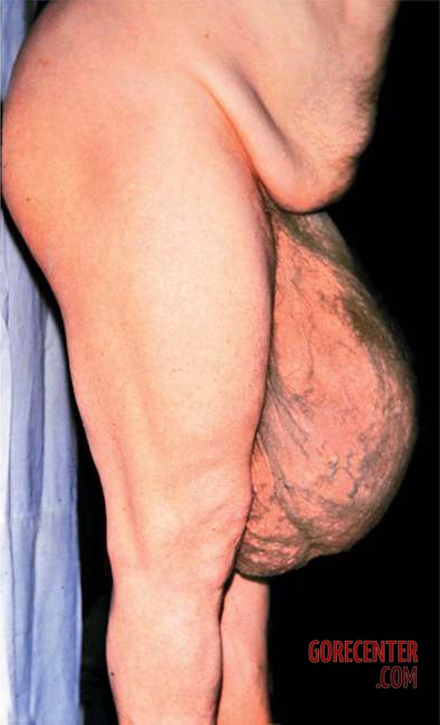 Large-right-inguinal-hernia-2.jpg