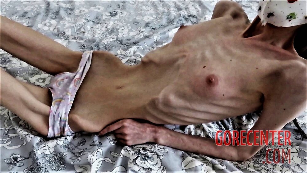 MIX-Extreme-cases-of-anorexia-1.jpg