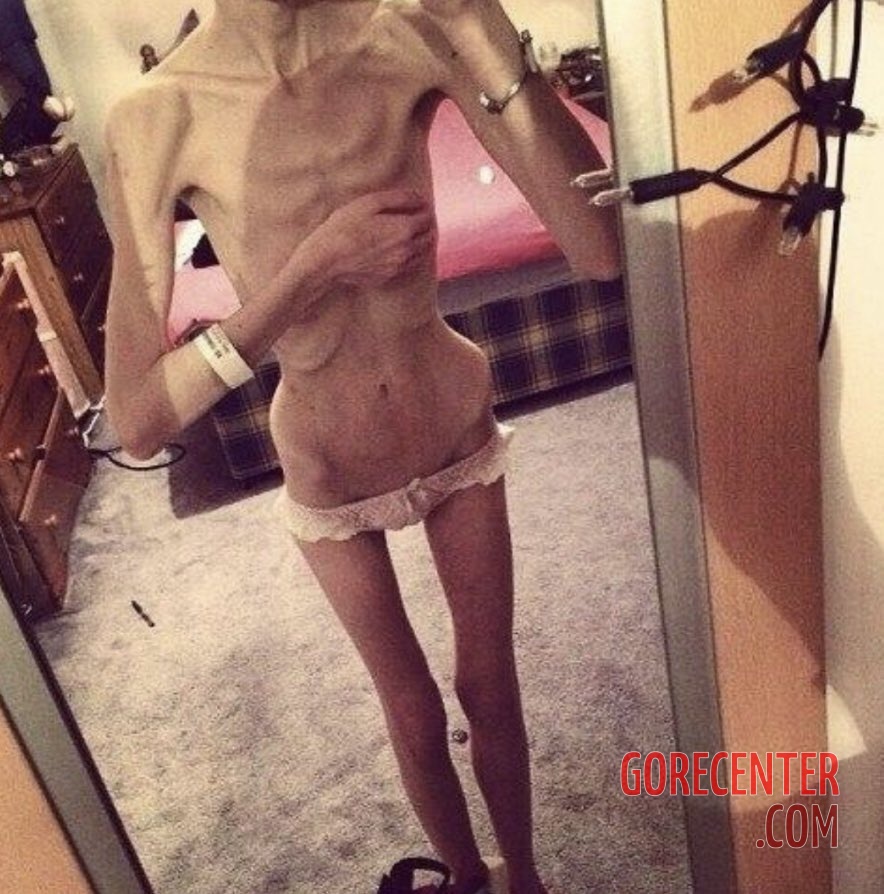 MIX-Extreme-cases-of-anorexia-23.jpg