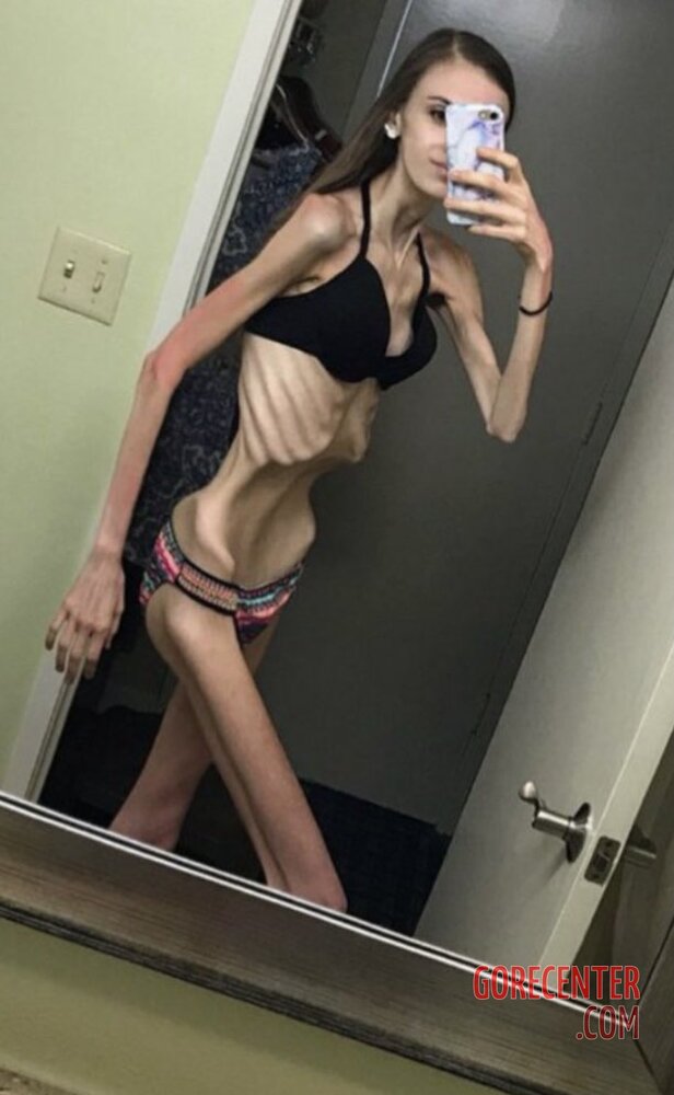 MIX-Extreme-cases-of-anorexia-24.jpg