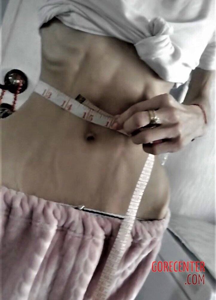 MIX-Extreme-cases-of-anorexia-27.jpg