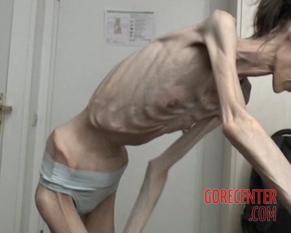 MIX-Extreme-cases-of-anorexia-28.jpg