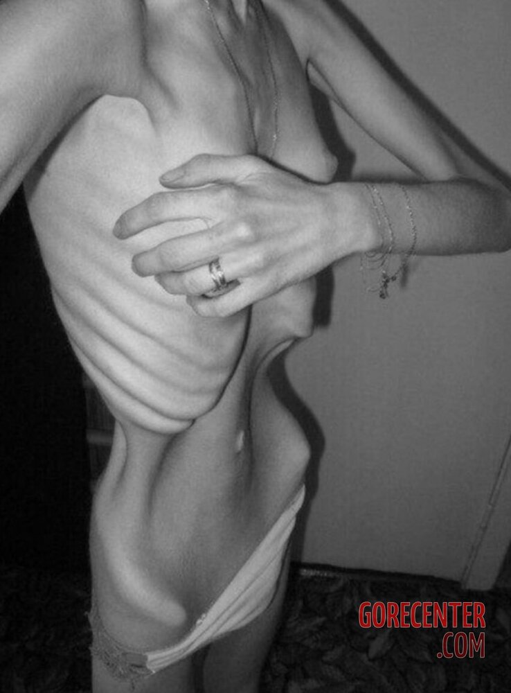 MIX-Extreme-cases-of-anorexia-34.jpg