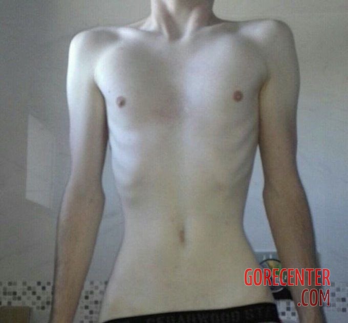 MIX-Extreme-cases-of-anorexia-46.jpg