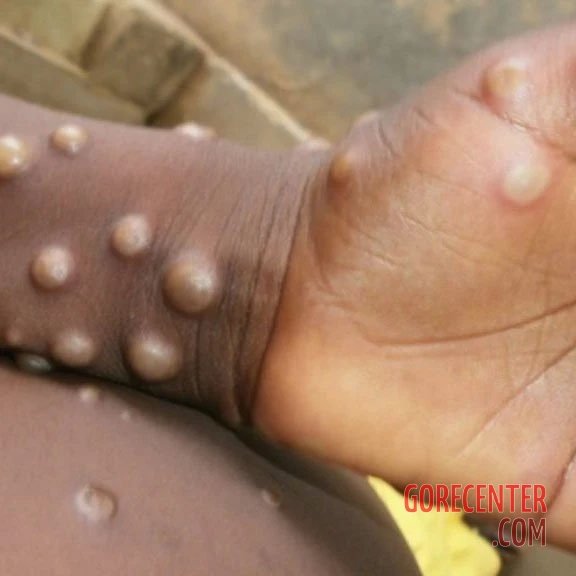 MIX_-People-infected-with-mpox-10.jpg