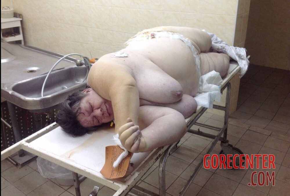 Morbidly-obese-woman-in-morgue-11.jpg