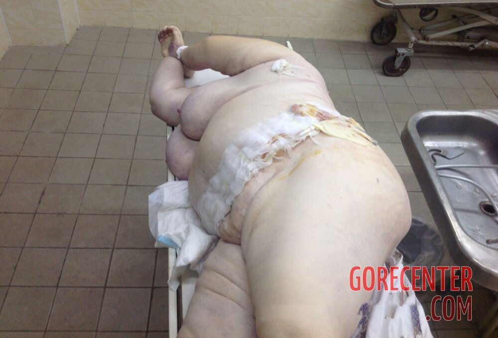 Morbidly-obese-woman-in-morgue-12.jpg