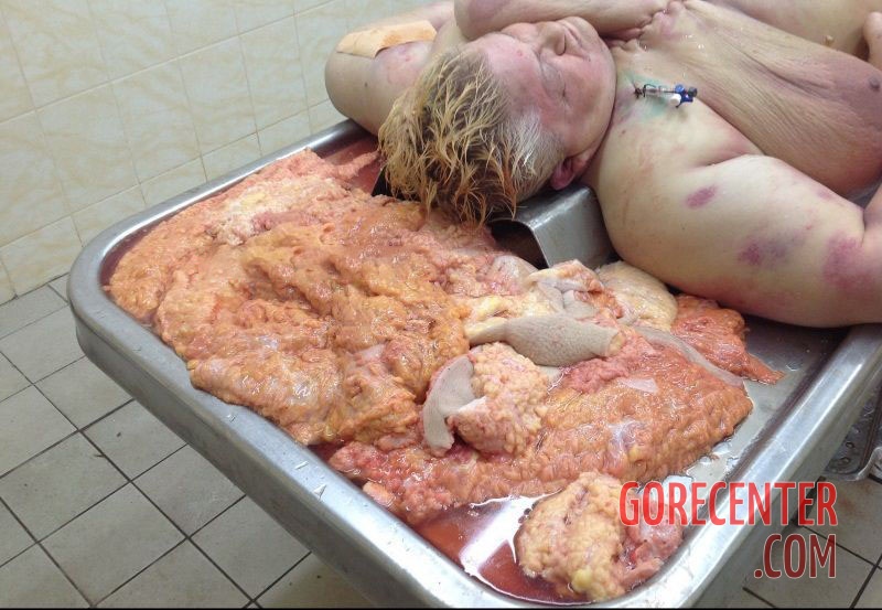 Morbidly-obese-woman-in-morgue-5.jpg