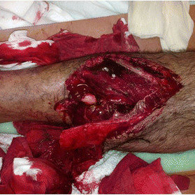 Open-degloving-with-flap-and-underlying-bony-injury_Q320.jpg