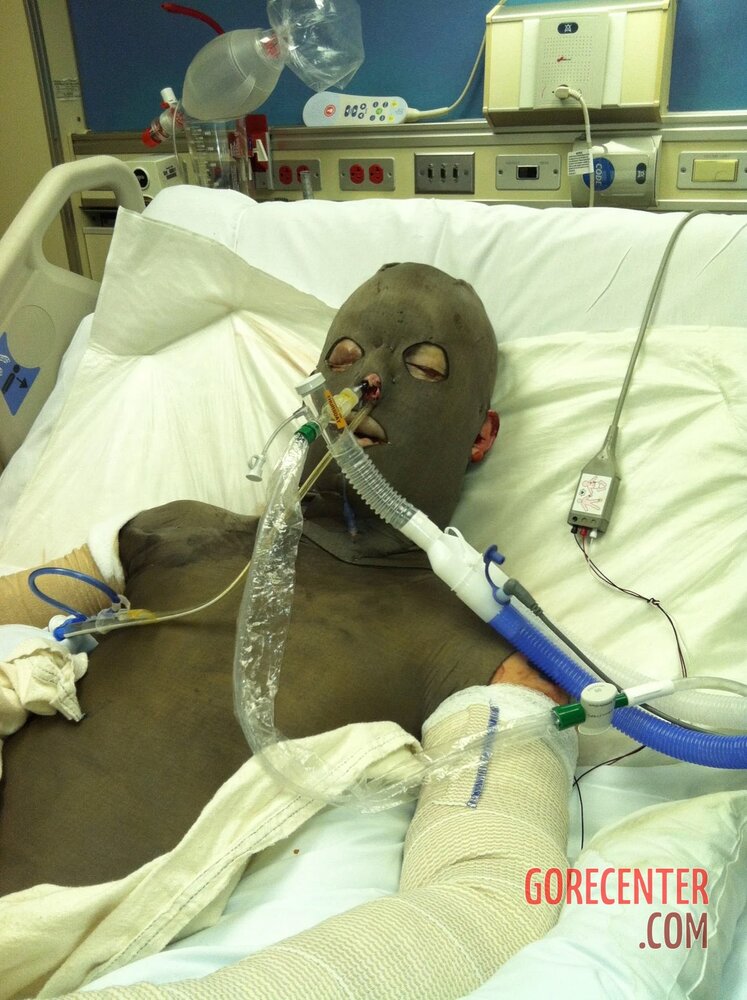 Patient-with-severe-burns-all-over-his-body-3.jpg