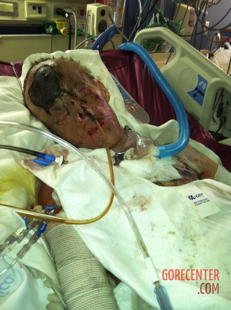 Patient-with-severe-burns-all-over-his-body-5.jpg