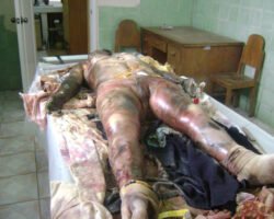 Rotten-woman-on-morgue-table-2-250x200.jpg