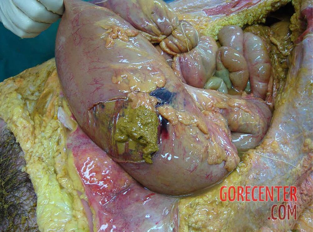 Ruptured-colon-caused-her-death-1.jpg