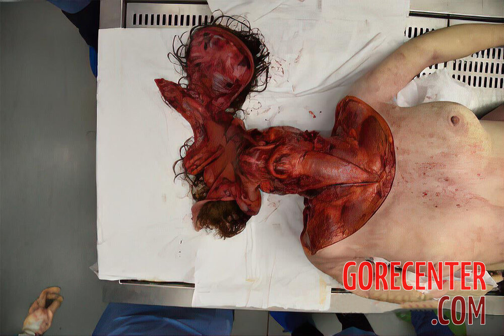 Skinned-woman-on-autopsy-table-5.jpg