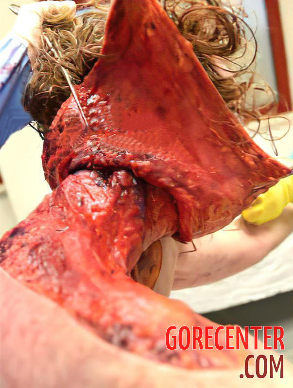 Skinned-woman-on-autopsy-table-7.jpg