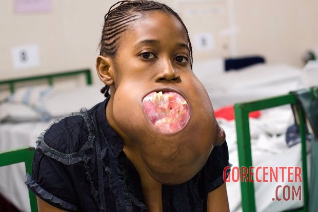 Teen-girl-with-huge-facial-tumor-2.jpg